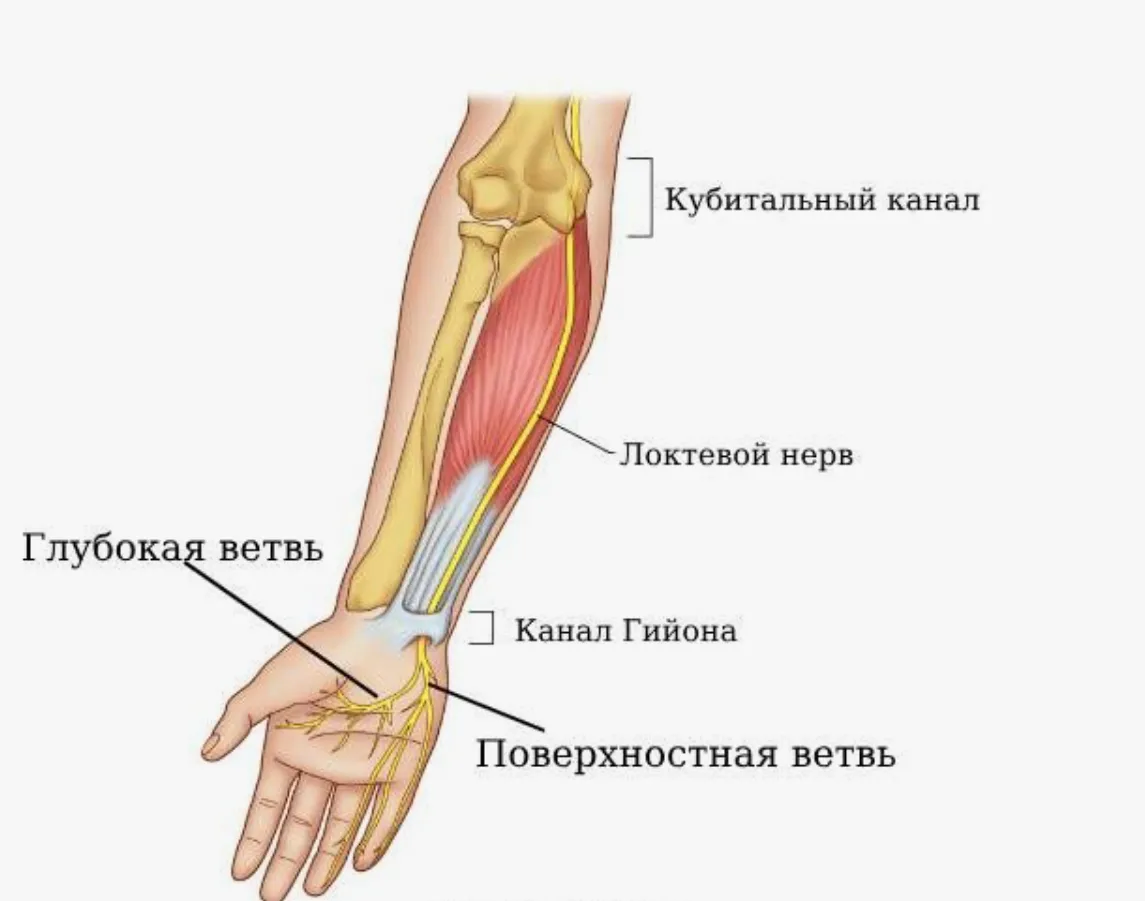 Лечение карпального туннельного синдрома