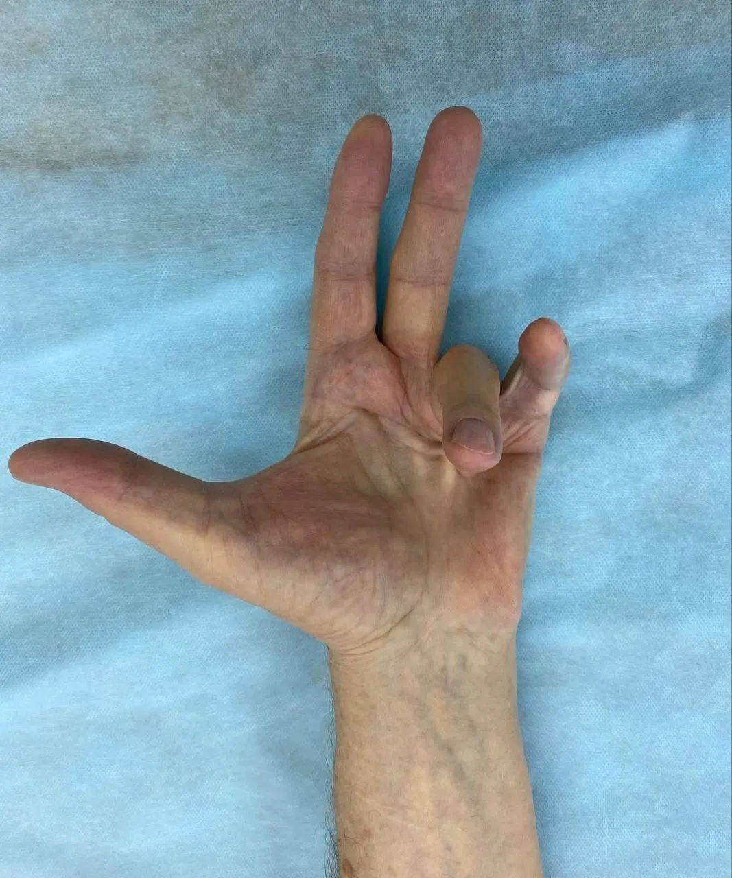 Артропластика суставов пальцев