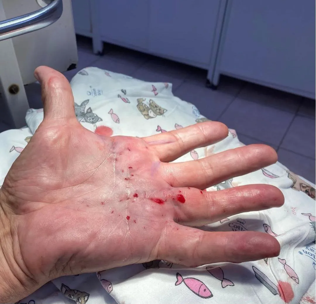 Лечение контрактуры Дюпюитрена