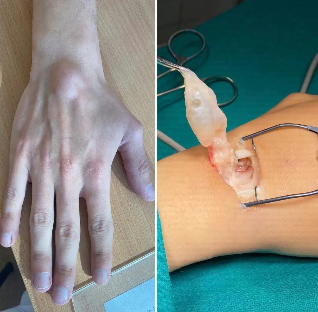 Лечение стенозирующего лигаментита