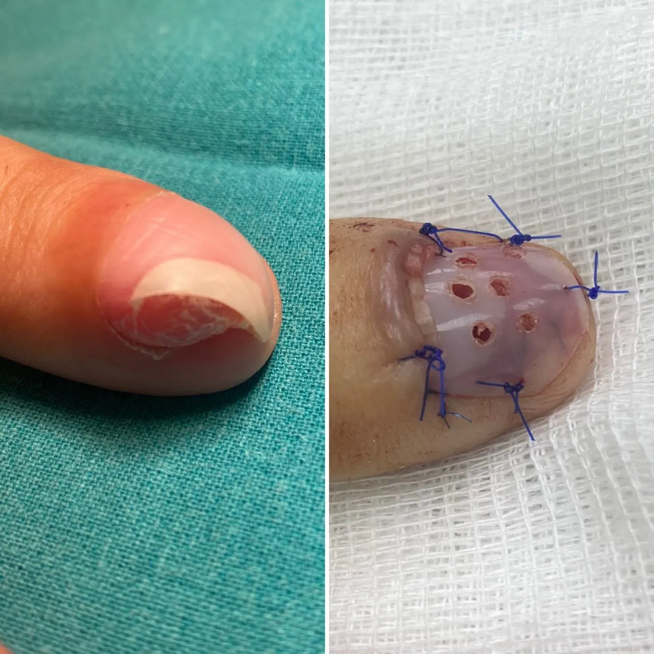 Тенолиз - освобождение сухожилий