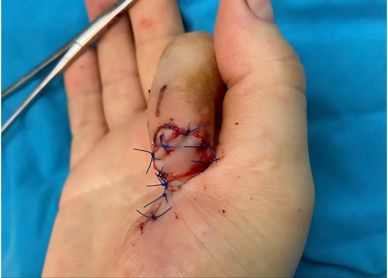 Реконструктивные операции кисти