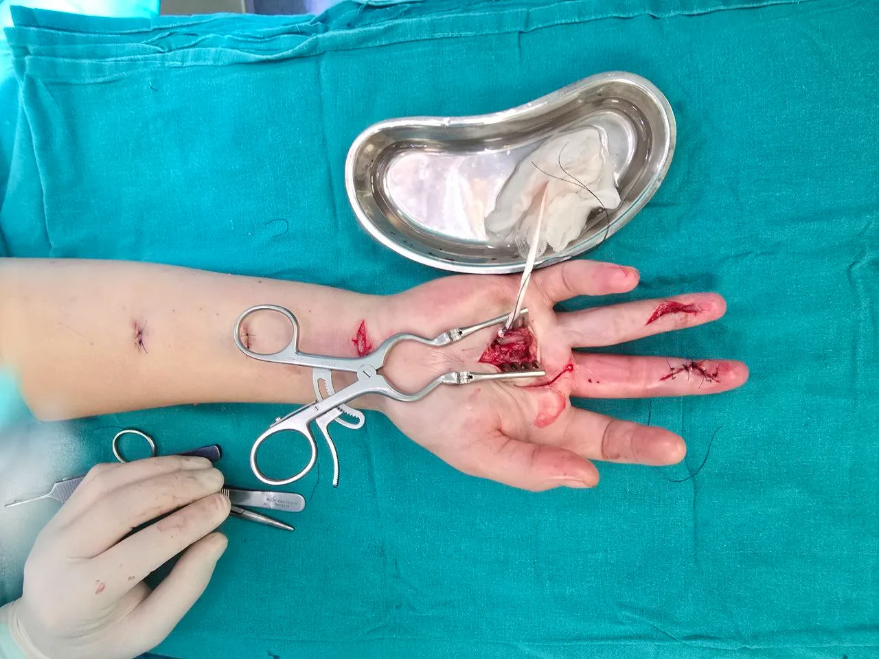 Пластика рубцовых деформаций