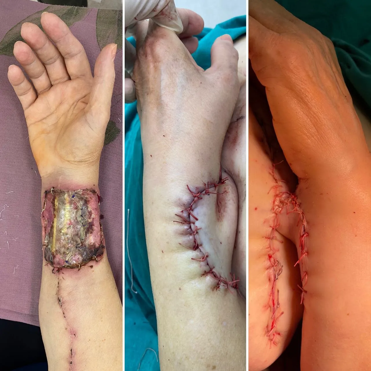 Реконструкция кисти